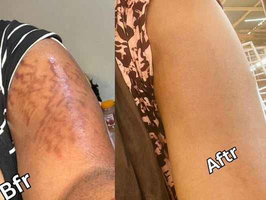 TRADITIONAL STRETCH MARKS AND SCAR OIL (big and small)