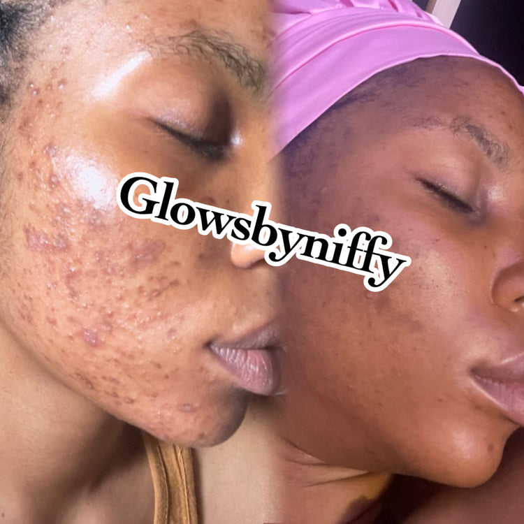Acne, Dark Spots and Hyperpigmentation Products