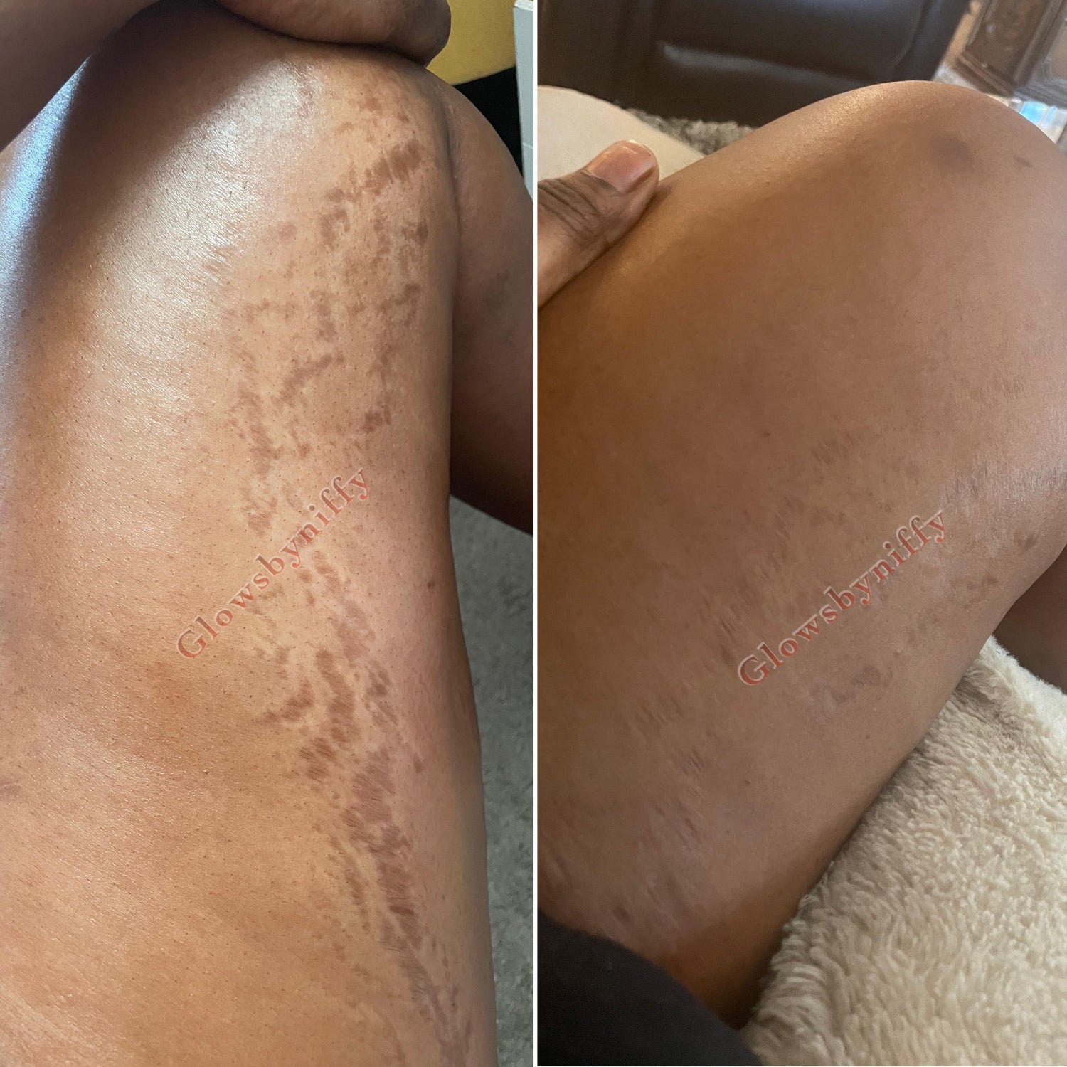 PFat Traditional stretch marks and scars products