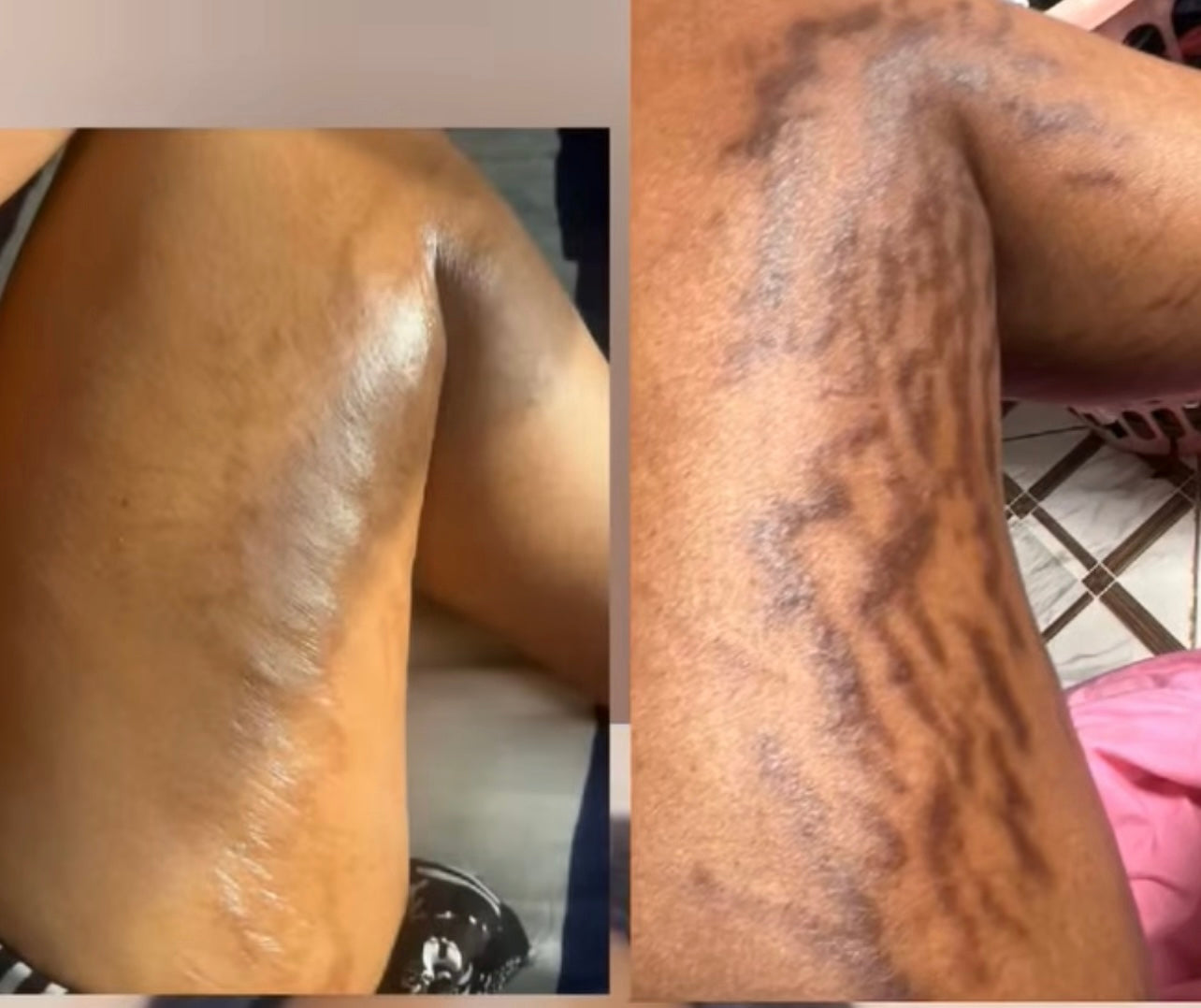 (SMALL) p fat 100% traditional stretch marks and scar oil