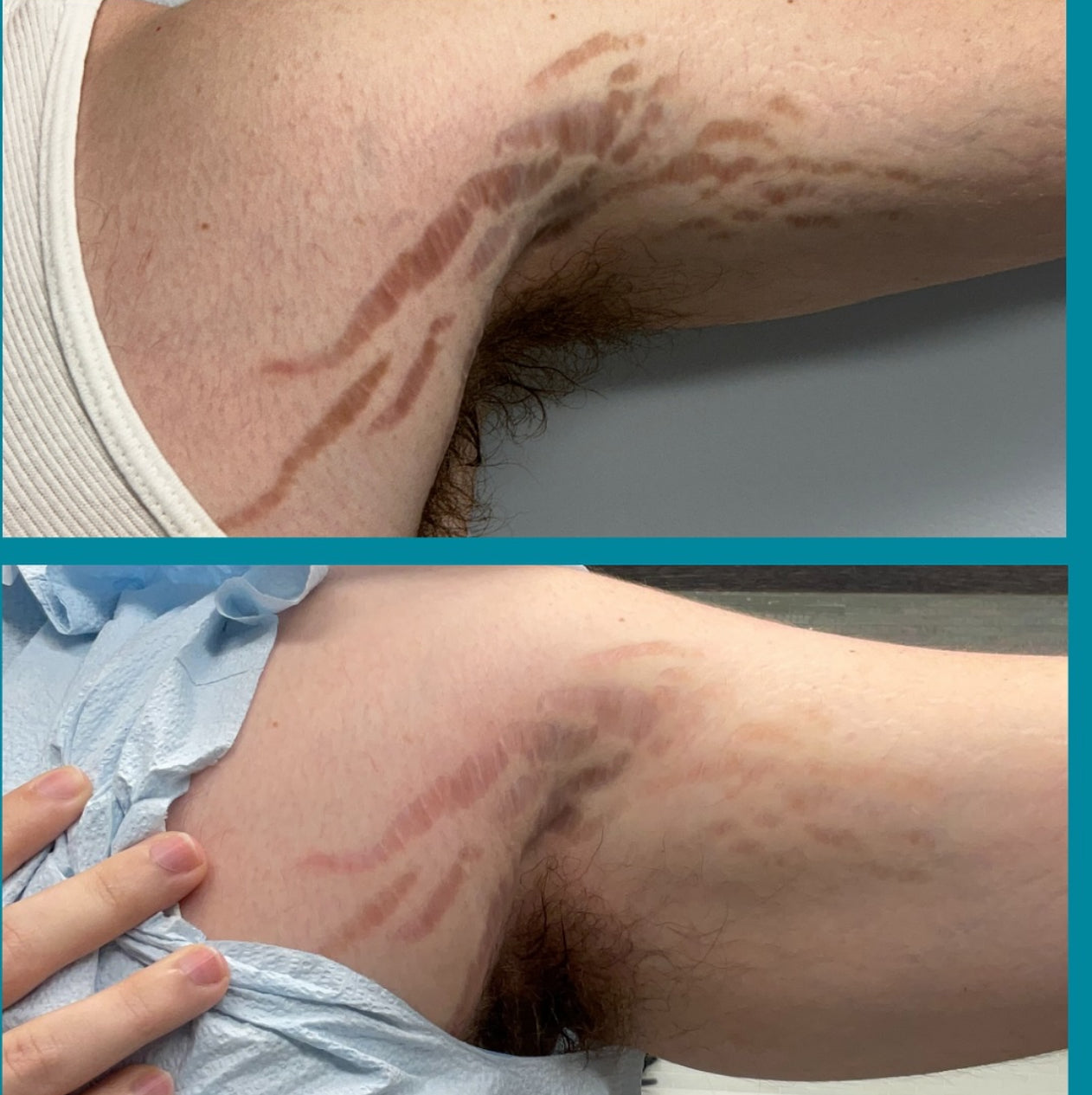 (SMALL) p fat 100% traditional stretch marks and scar oil