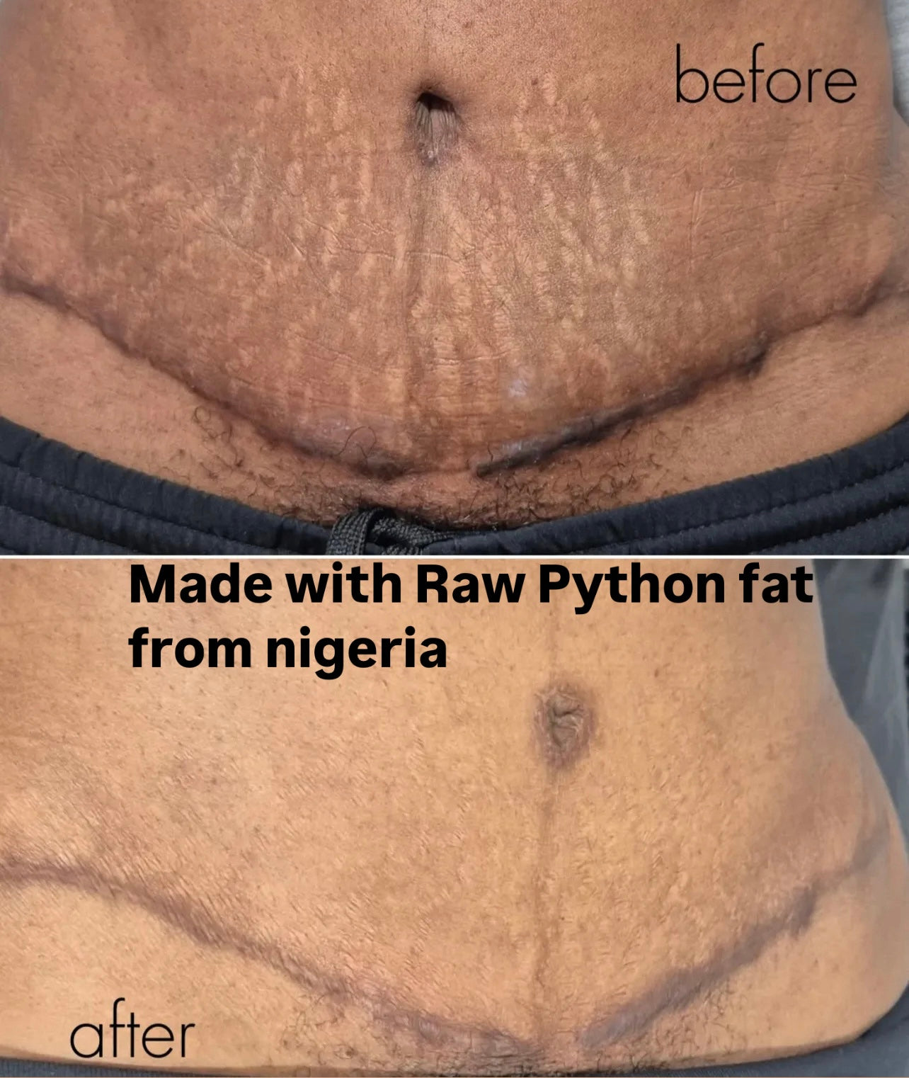 (BIG) P fat 100% traditional stretch marks and scar oil