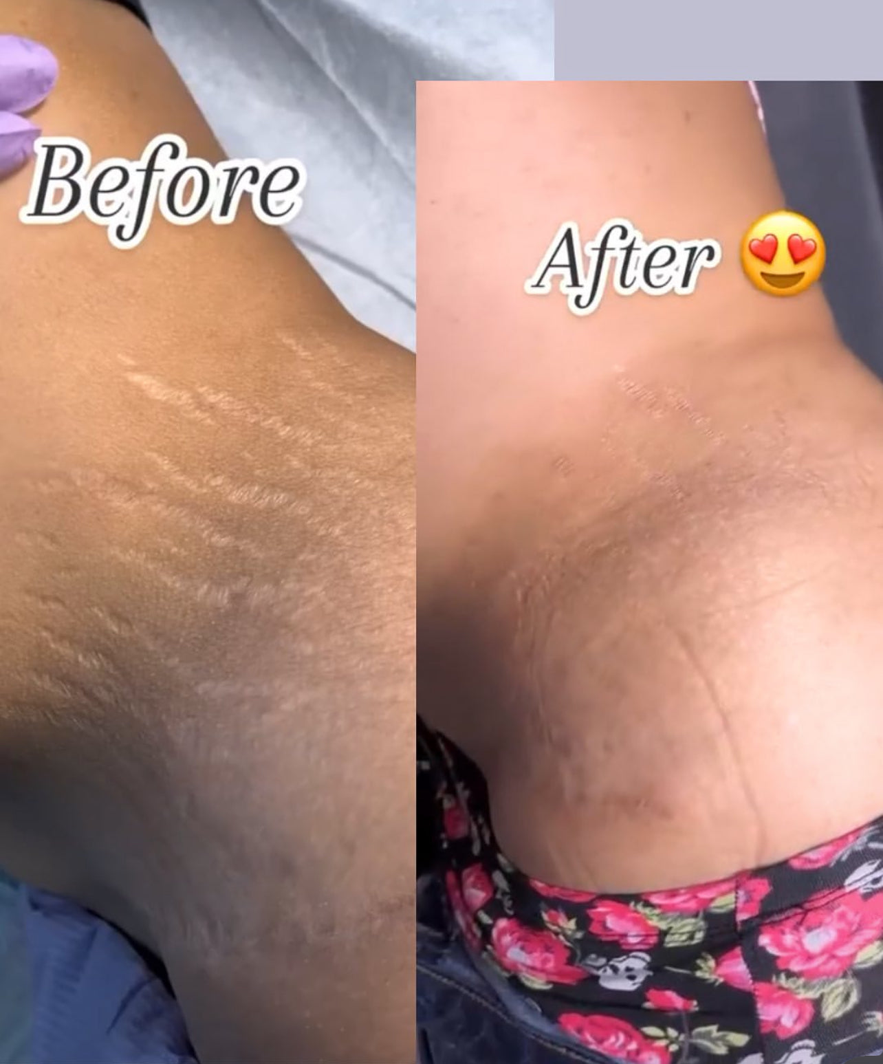 (SMALL) p fat 100% traditional stretch marks and scar oil