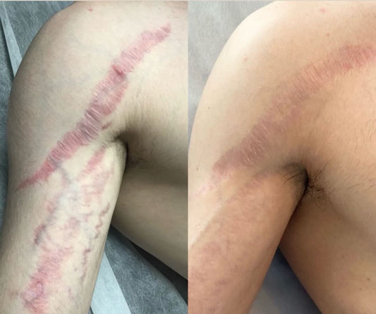 (BIG) P fat 100% traditional stretch marks and scar oil
