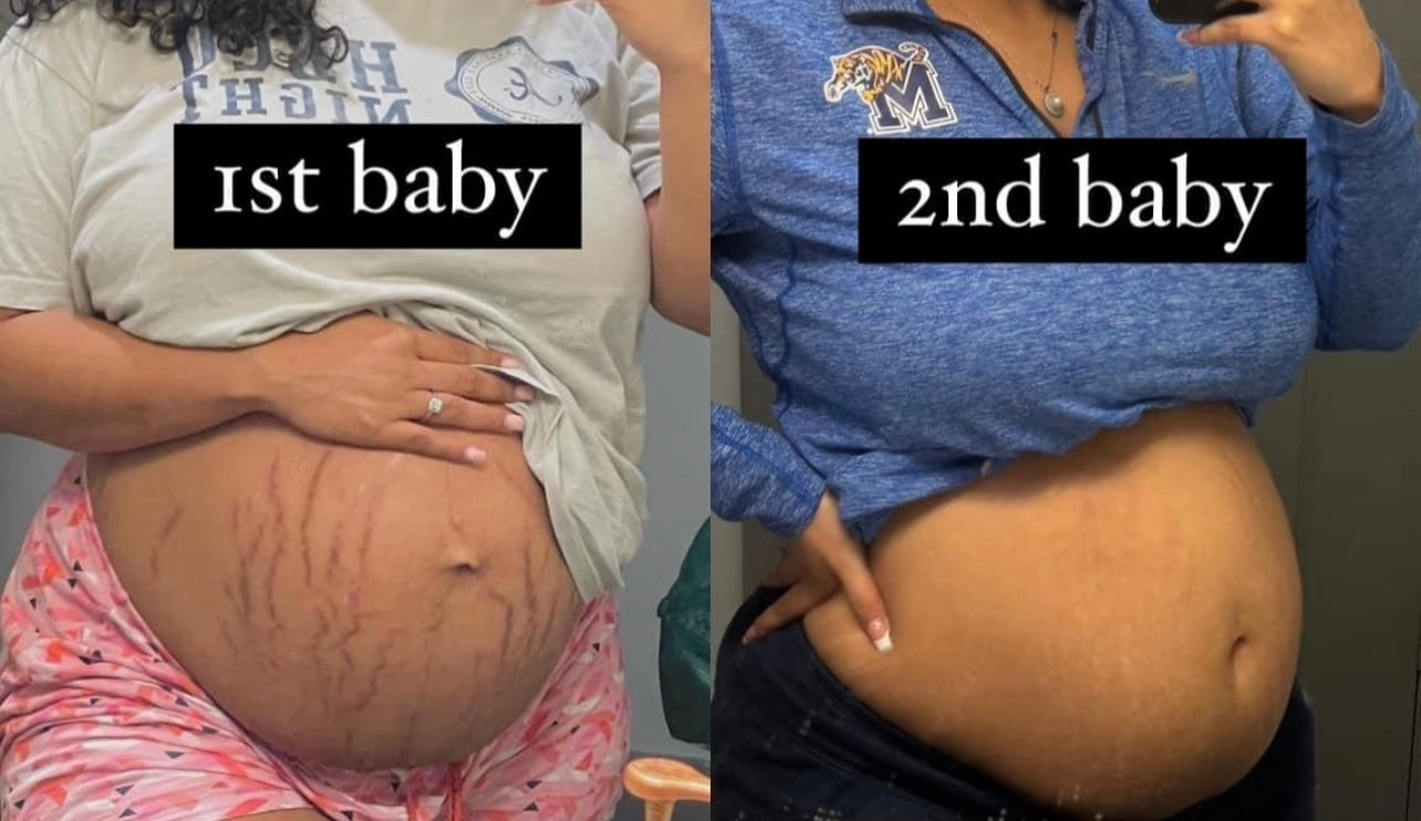 (SMALL) p fat 100% traditional stretch marks and scar oil