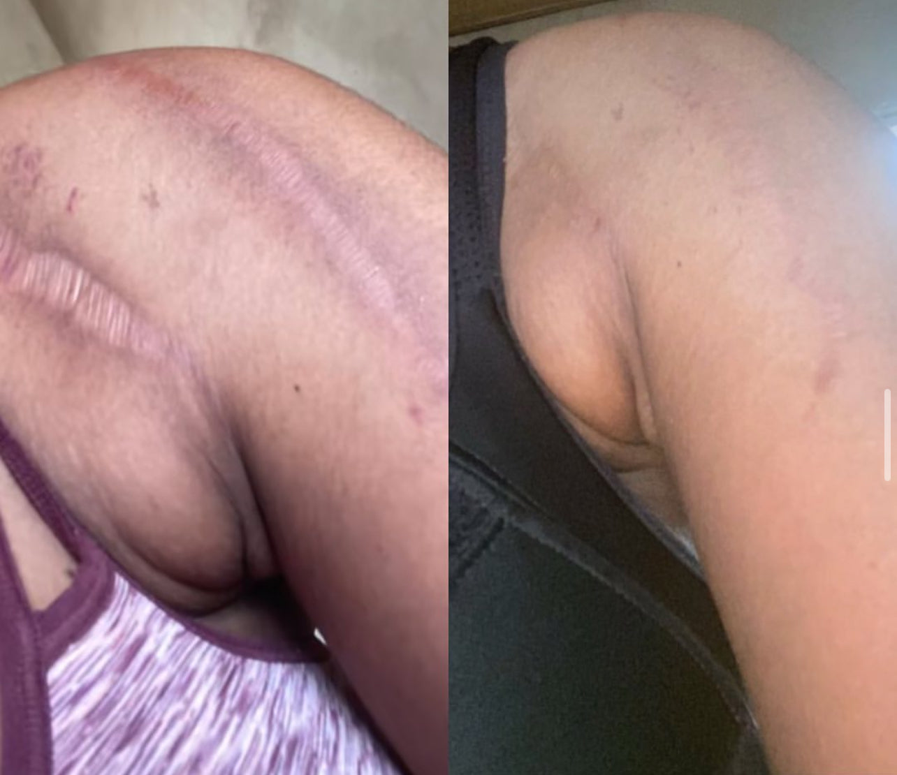 (SMALL) p fat 100% traditional stretch marks and scar oil